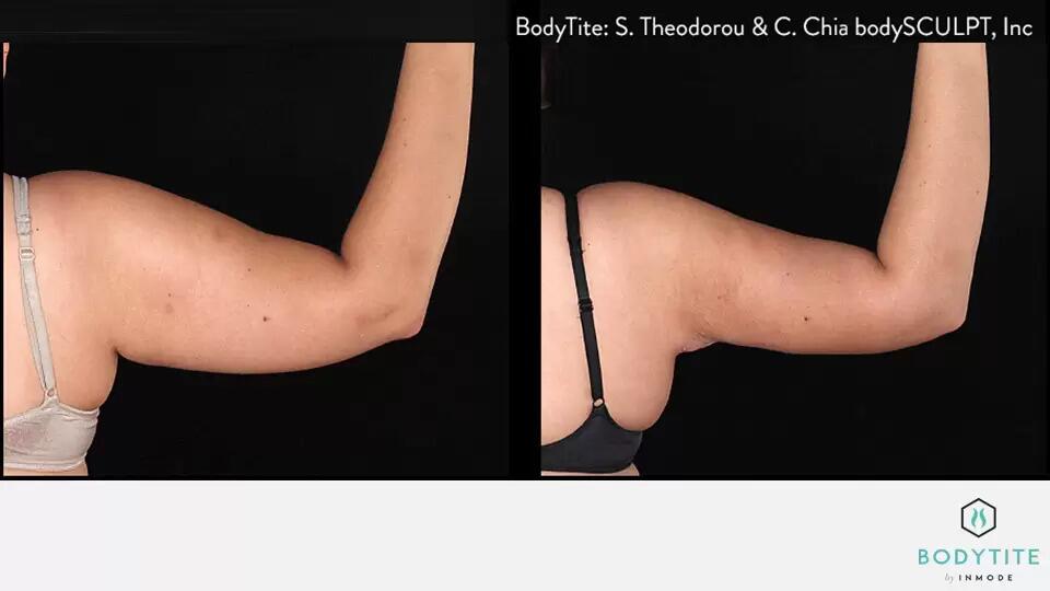 Body Sculpting Before & After Image