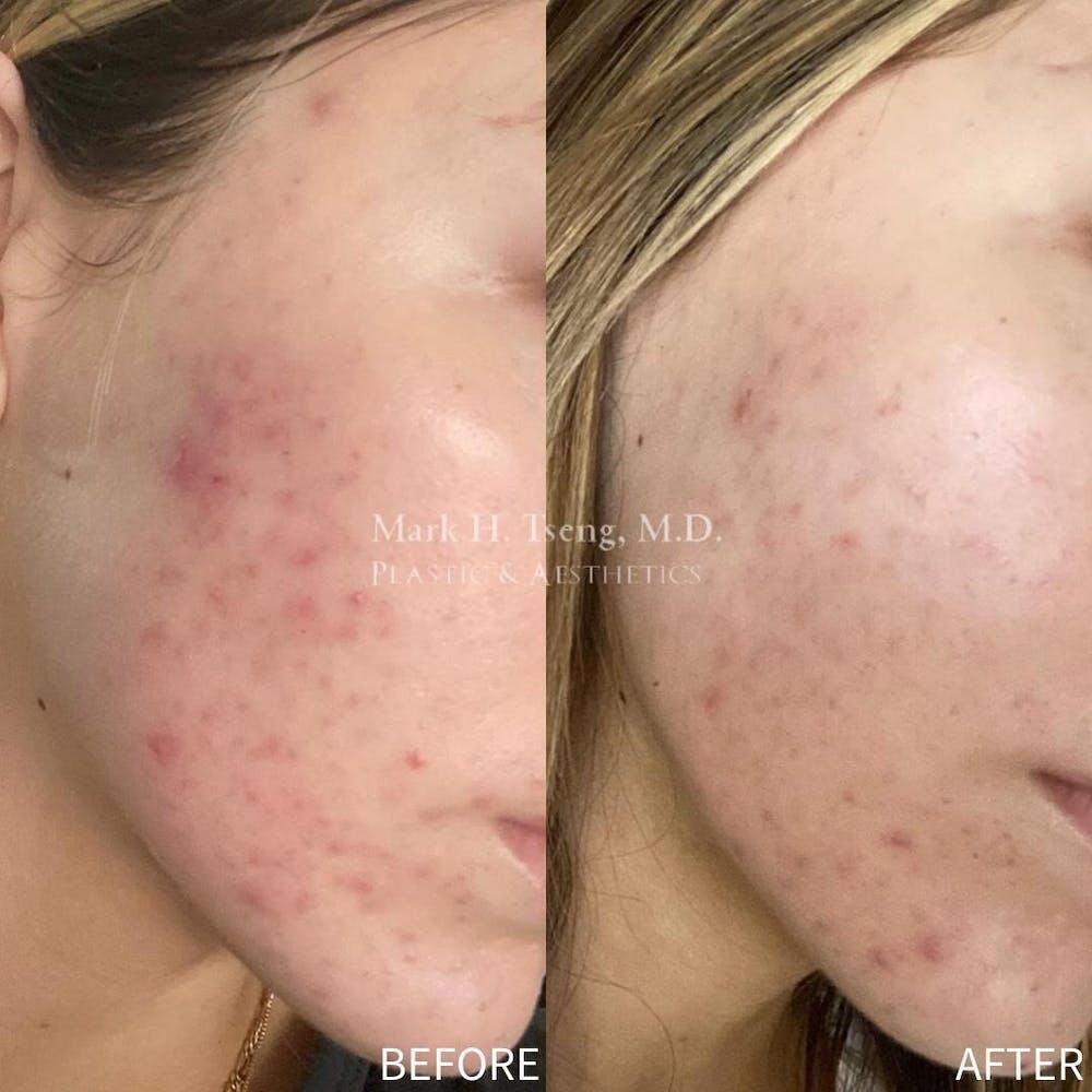 Chemical Peels Before & After Image