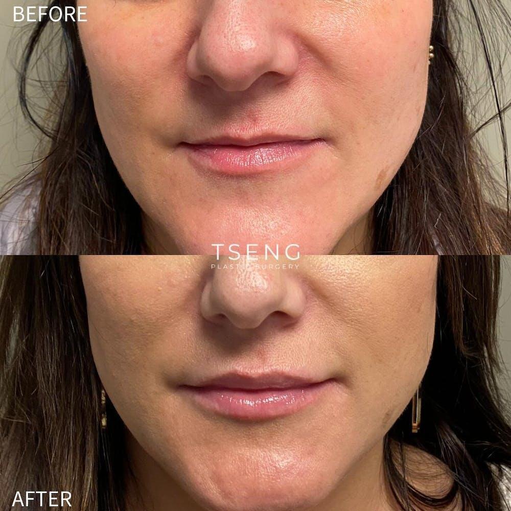 Dermal Fillers Before & After Image