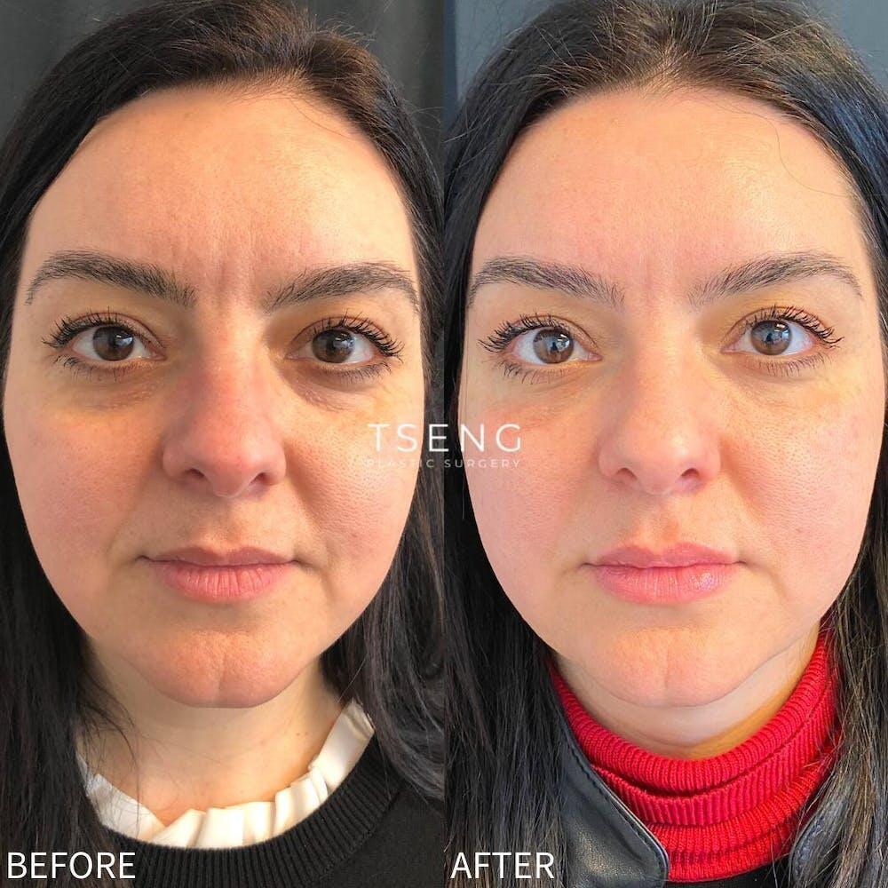 Dermal Fillers Before & After Image