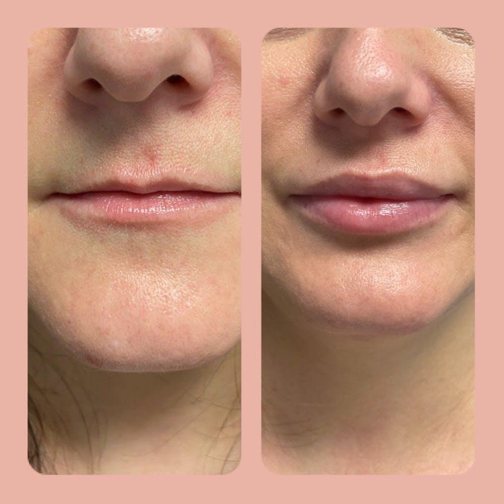 Dermal Fillers Before & After Image