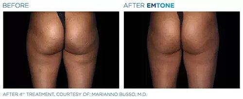 EmTone Before & After Image