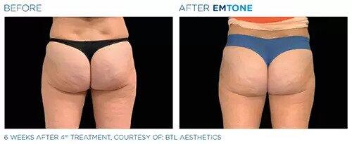 EmTone Before & After Image