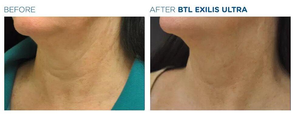 Exilis Ultra Before & After Image