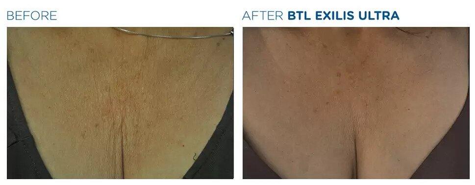 Exilis Ultra Before & After Image