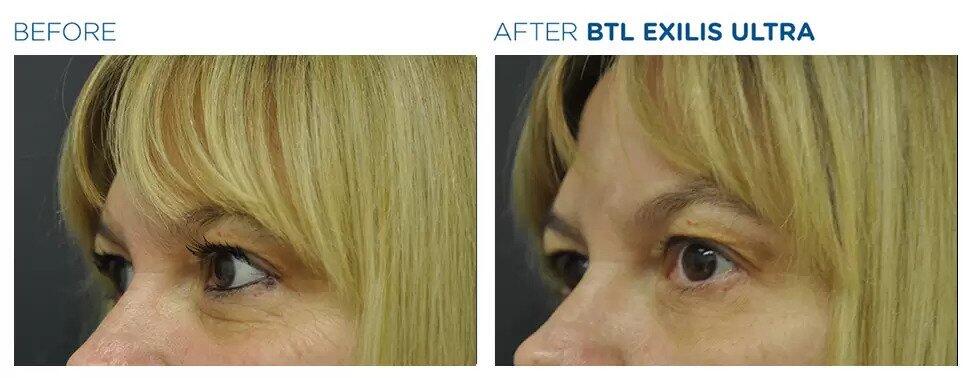 Exilis Ultra Before & After Image