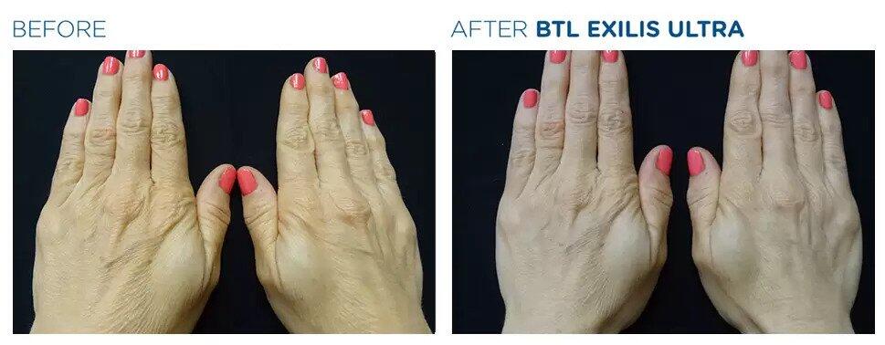 Exilis Ultra Before & After Image