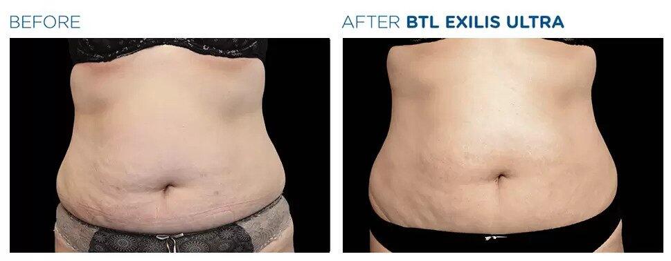 Exilis Ultra Before & After Image