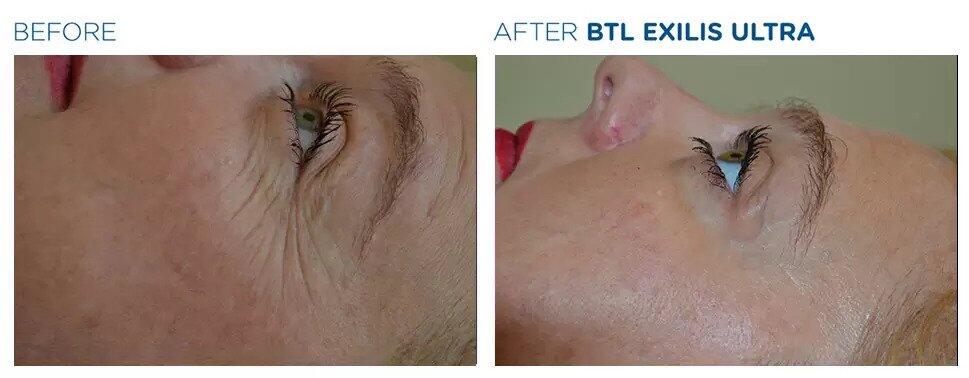 Exilis Ultra Before & After Image