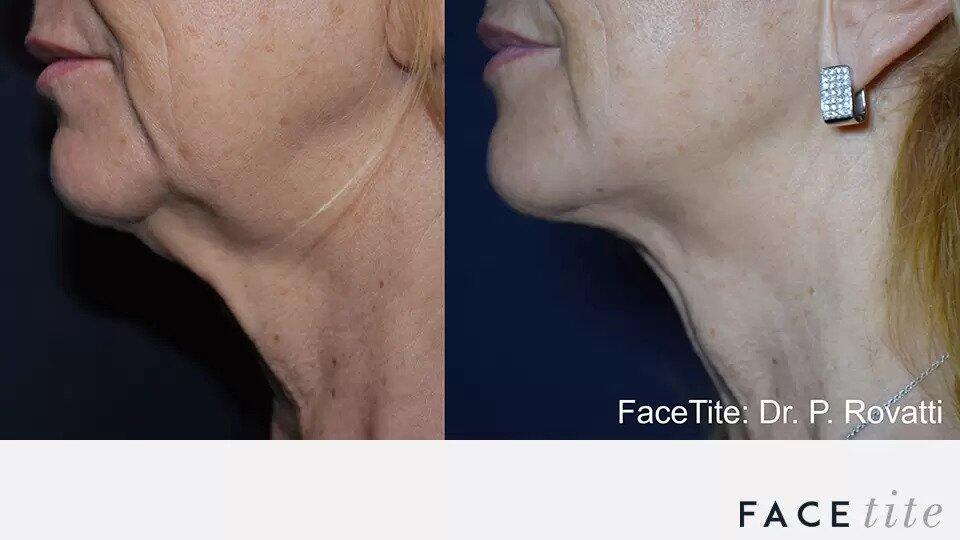 FaceTite Before & After Image