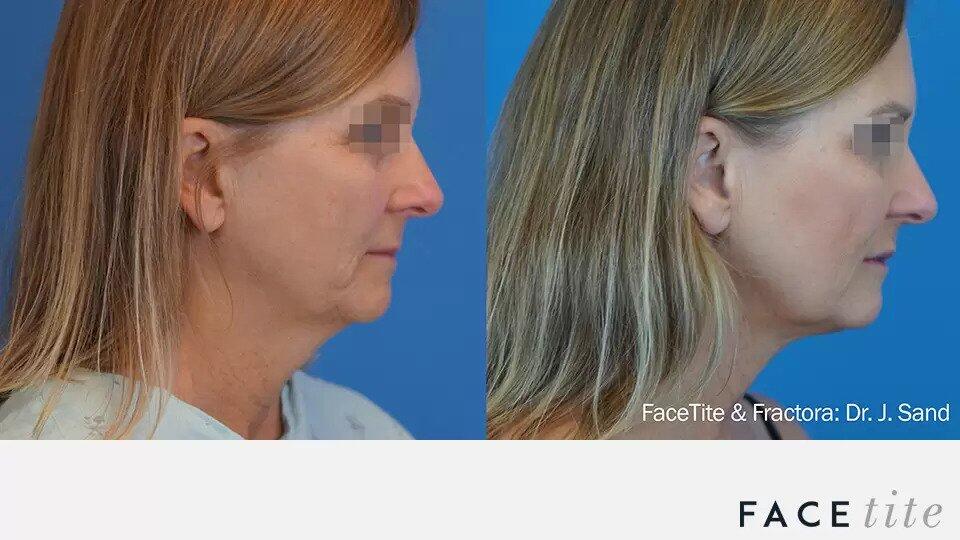 FaceTite Before & After Image