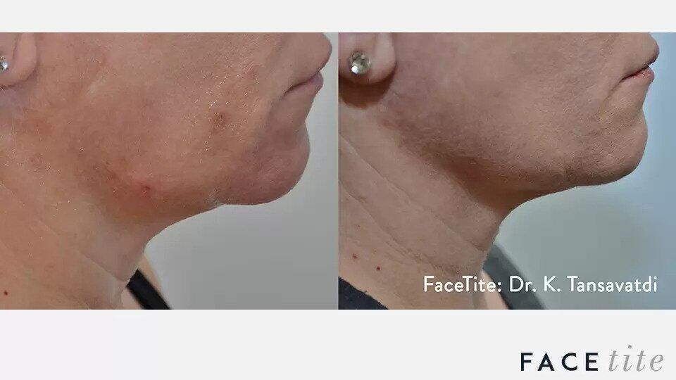 FaceTite Before & After Image