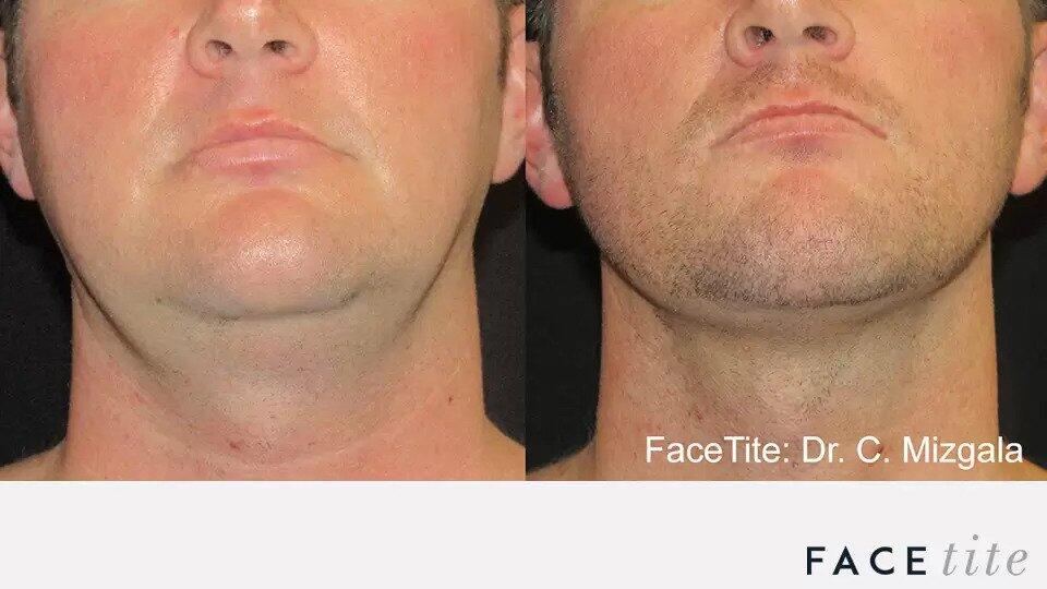 FaceTite Before & After Image