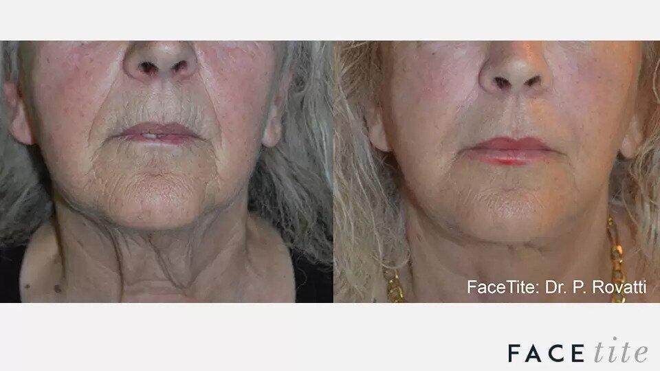 FaceTite Before & After Image