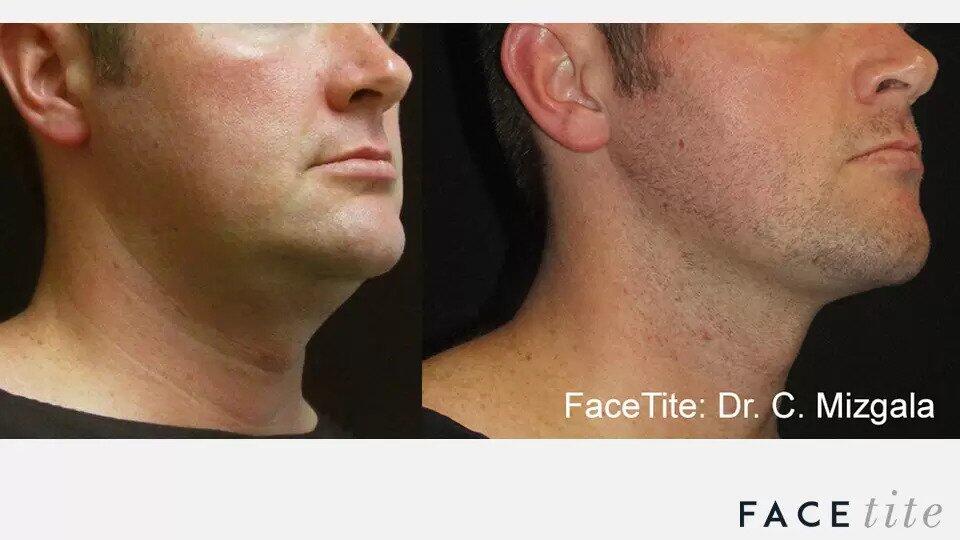 FaceTite Before & After Image
