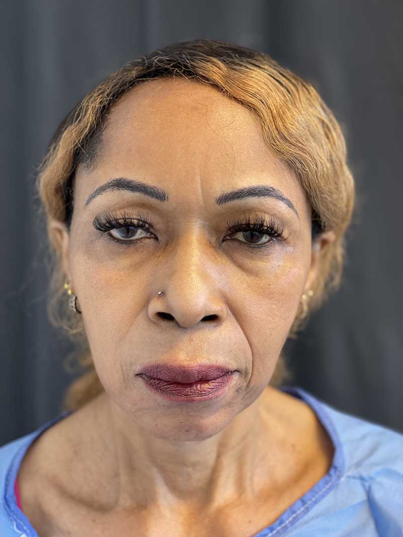FaceTite Before & After Image