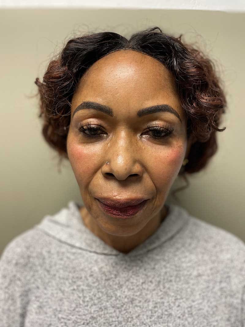 FaceTite Before & After Image