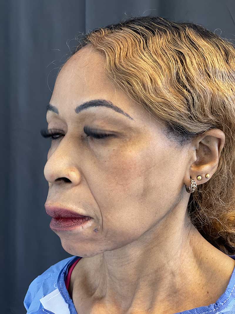 FaceTite Before & After Image