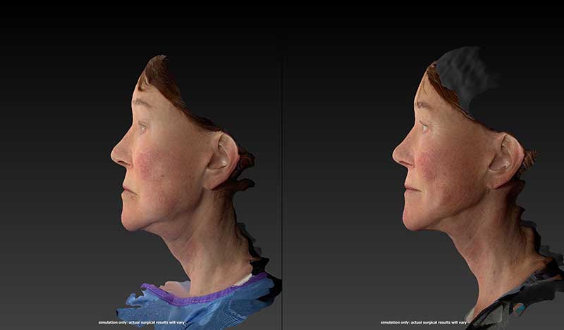FaceTite Before & After Image