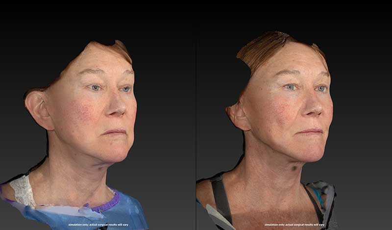 FaceTite Before & After Image
