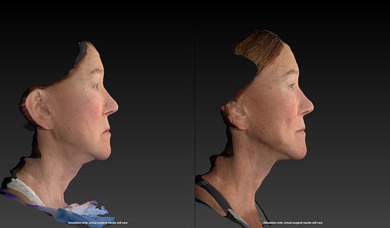 FaceTite Before & After Image
