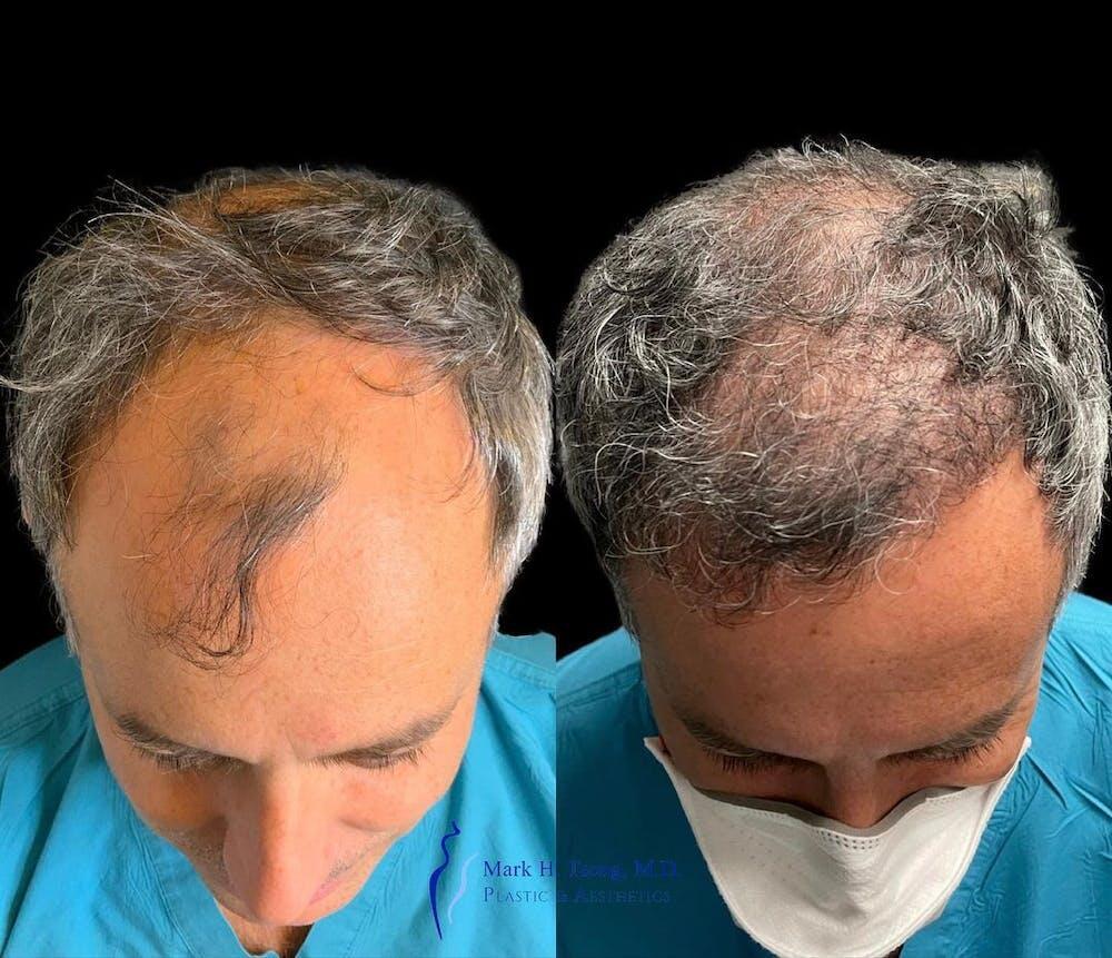 Hair Restoration Before & After Image
