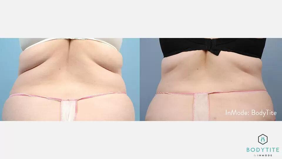 HD Liposuction Body Sculpting Before & After Image