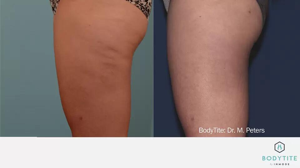 HD Liposuction Body Sculpting Before & After Image