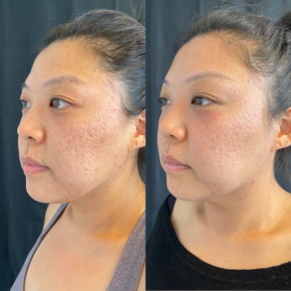 LaseMD Before & After Image