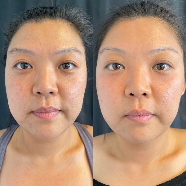 LaseMD Before & After Image