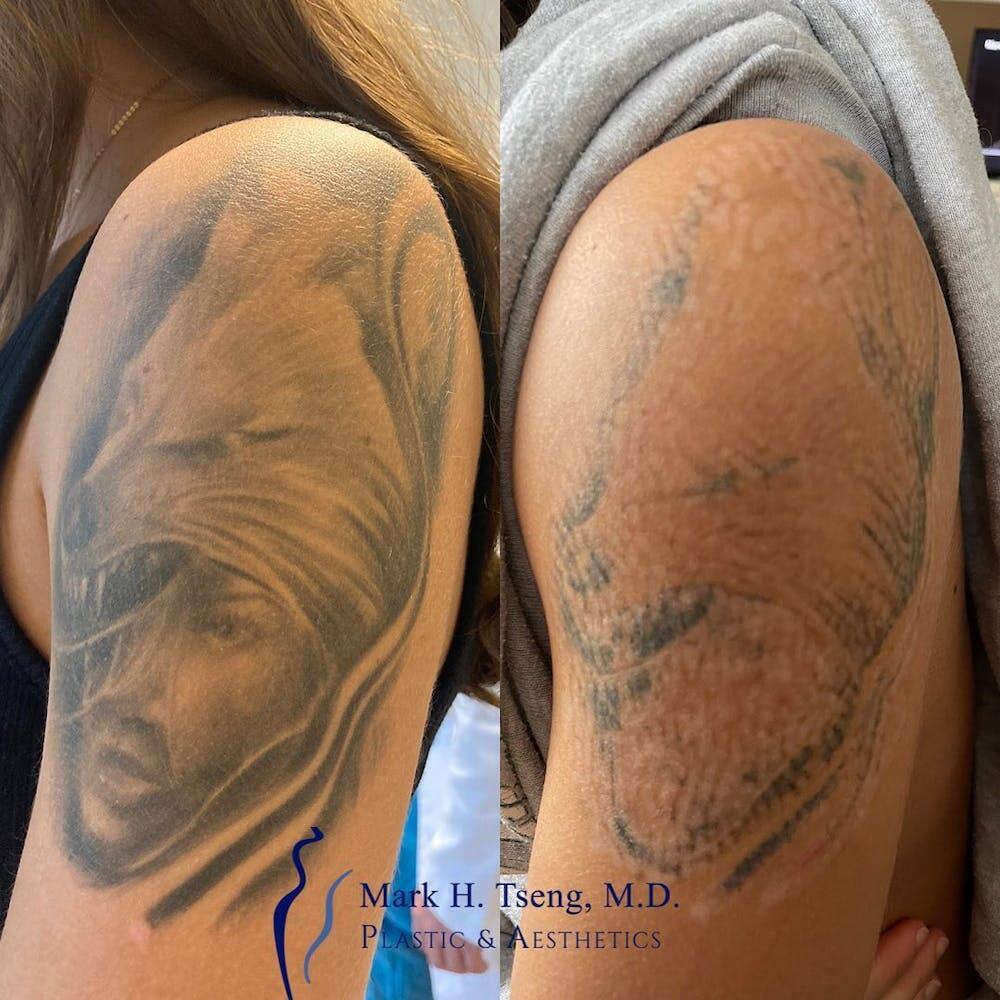 Laser Tattoo Removal Before & After Image