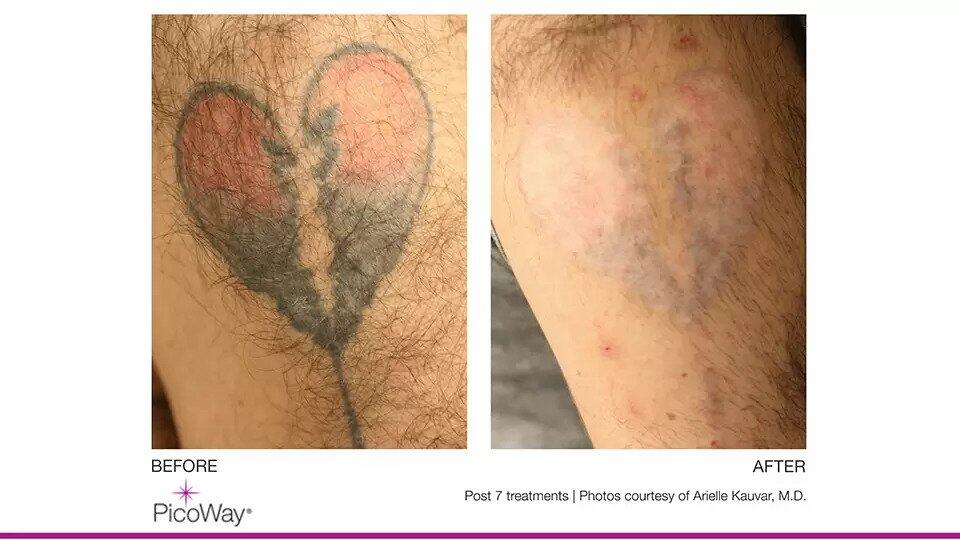 Laser Tattoo Removal Before & After Image