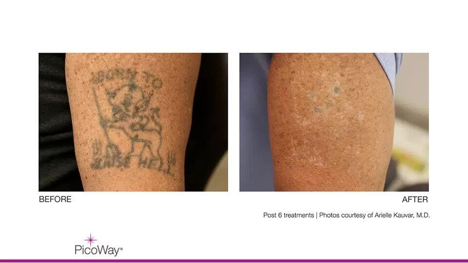 Laser Tattoo Removal Before & After Image