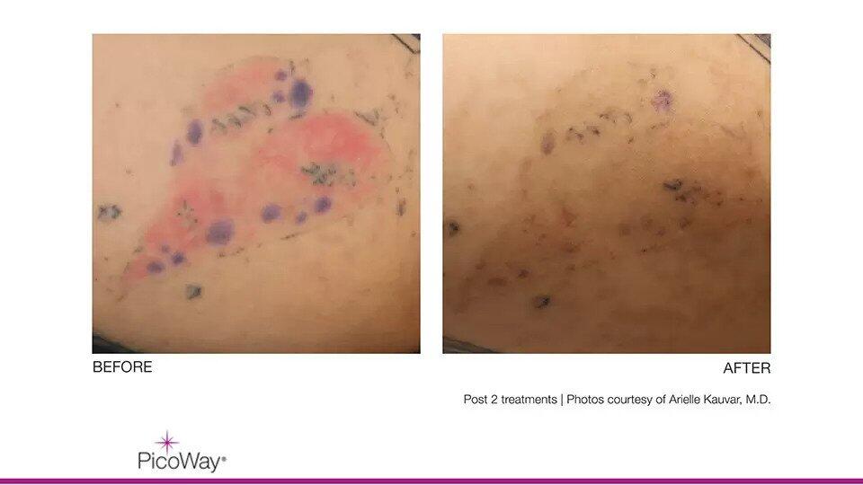 Laser Tattoo Removal Before & After Image