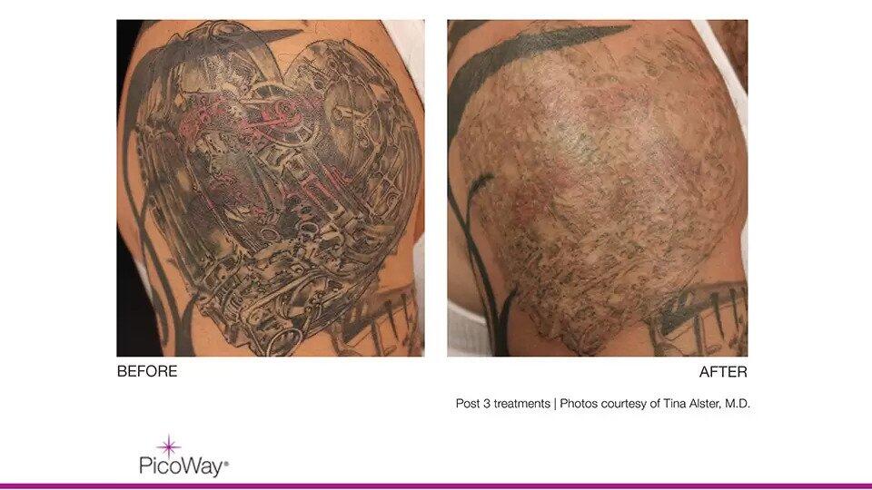 Laser Tattoo Removal Before & After Image