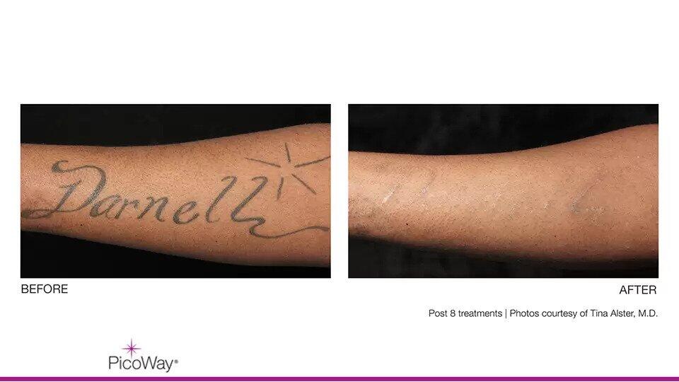 Laser Tattoo Removal Before & After Image