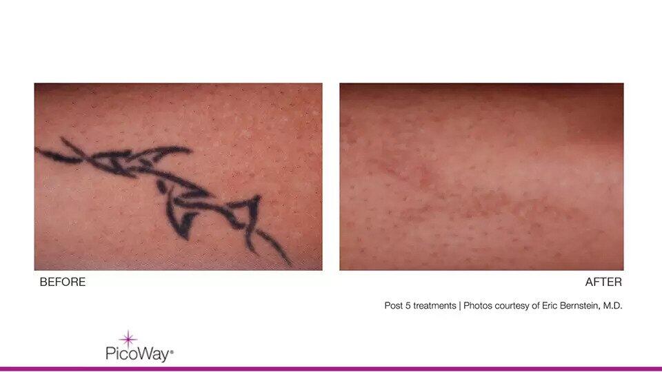 Laser Tattoo Removal Before & After Image