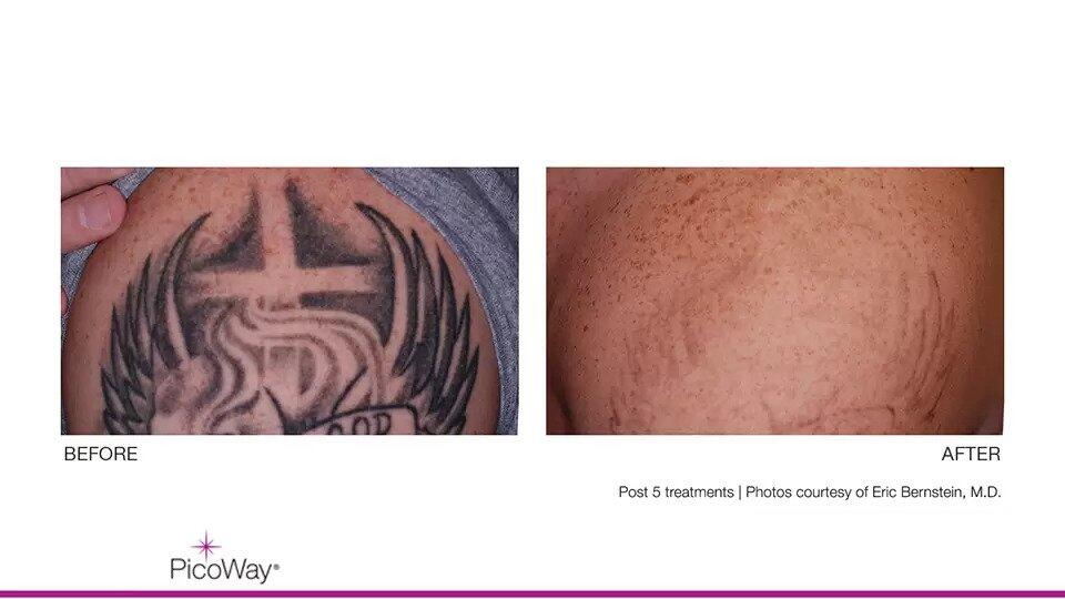 Laser Tattoo Removal Before & After Image