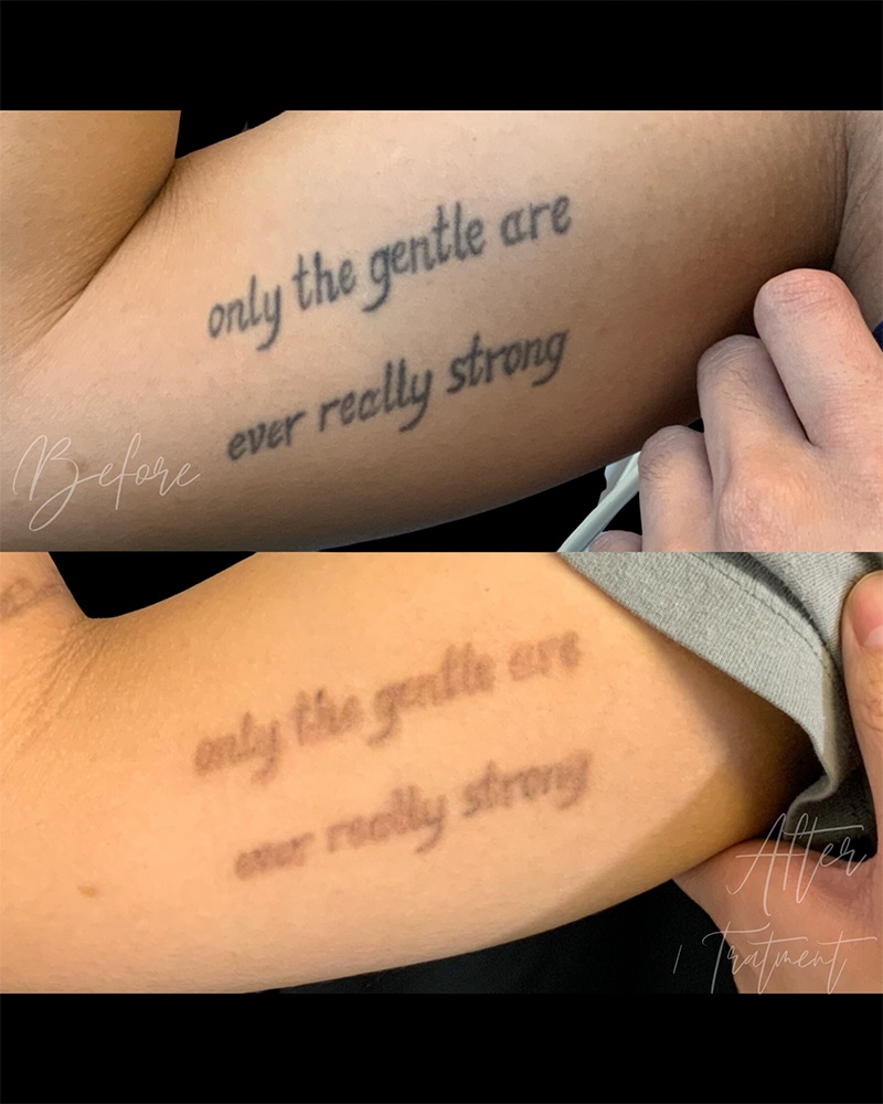 Laser Tattoo Removal Before & After Image