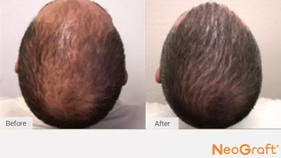 NeoGraft Before & After Image