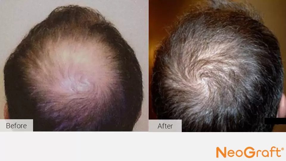 NeoGraft Before & After Image