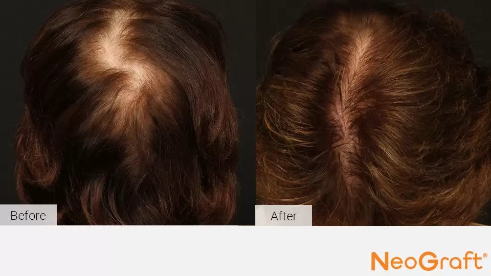 NeoGraft Before & After Image