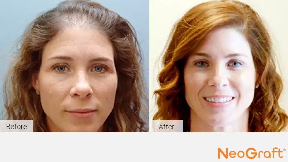 NeoGraft Before & After Image
