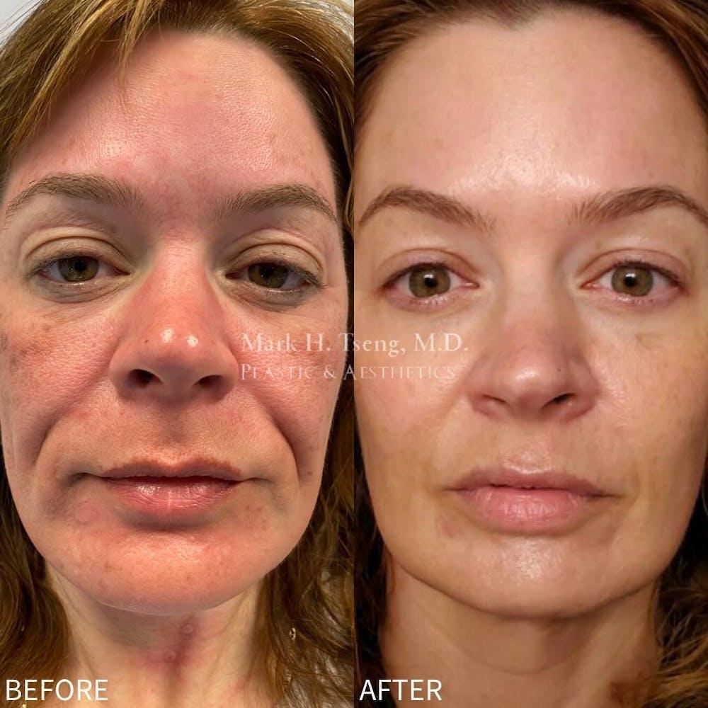 Non-Surgical Facelift Before & After Image