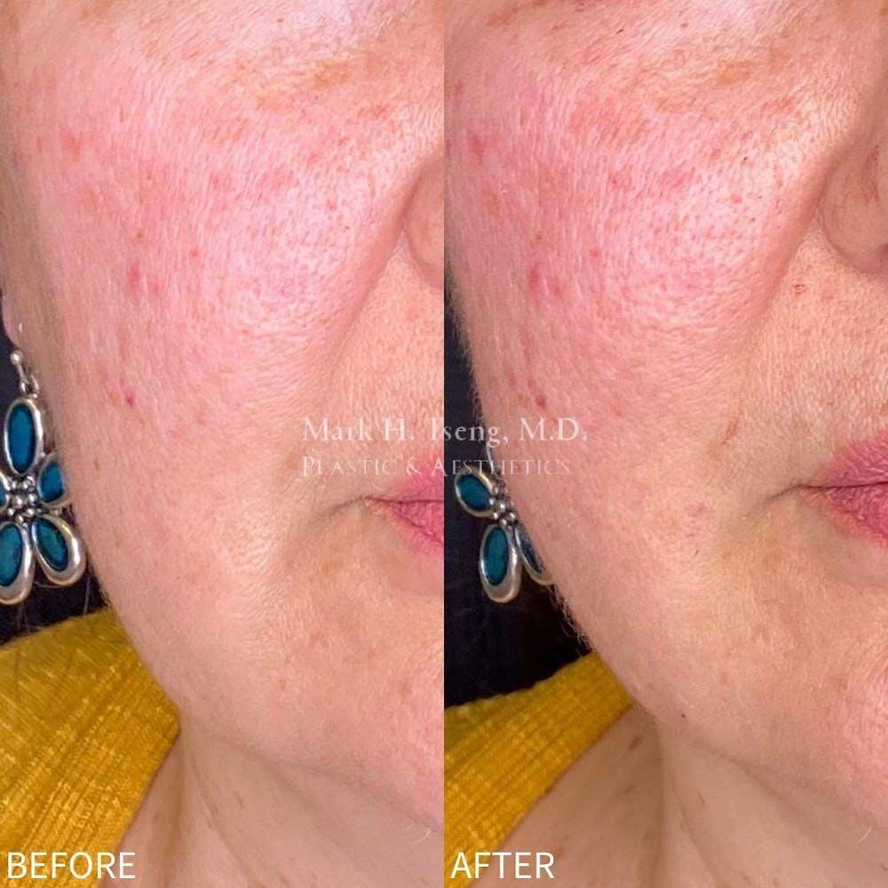 Non-Surgical Facelift Before & After Image