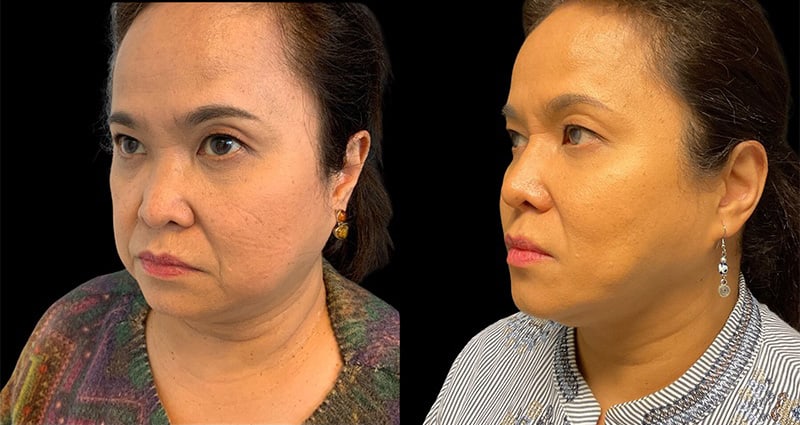 Non-Surgical Facelift Before & After Image