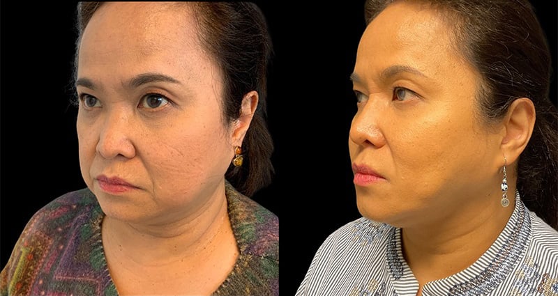 Non-Surgical Facelift Before & After Image