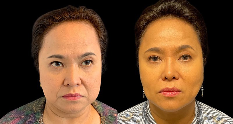 Non-Surgical Facelift Before & After Image