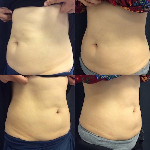 Vanquish Fat Reduction Before & After Image