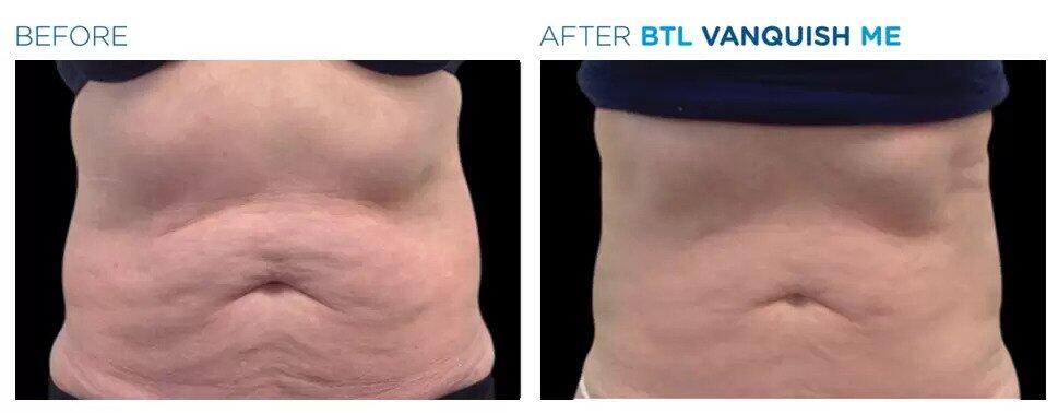 Vanquish Fat Reduction Before & After Image